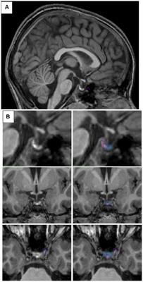 Prenatal paternal anxiety symptoms predict child DHEA levels and internalizing symptoms during adrenarche